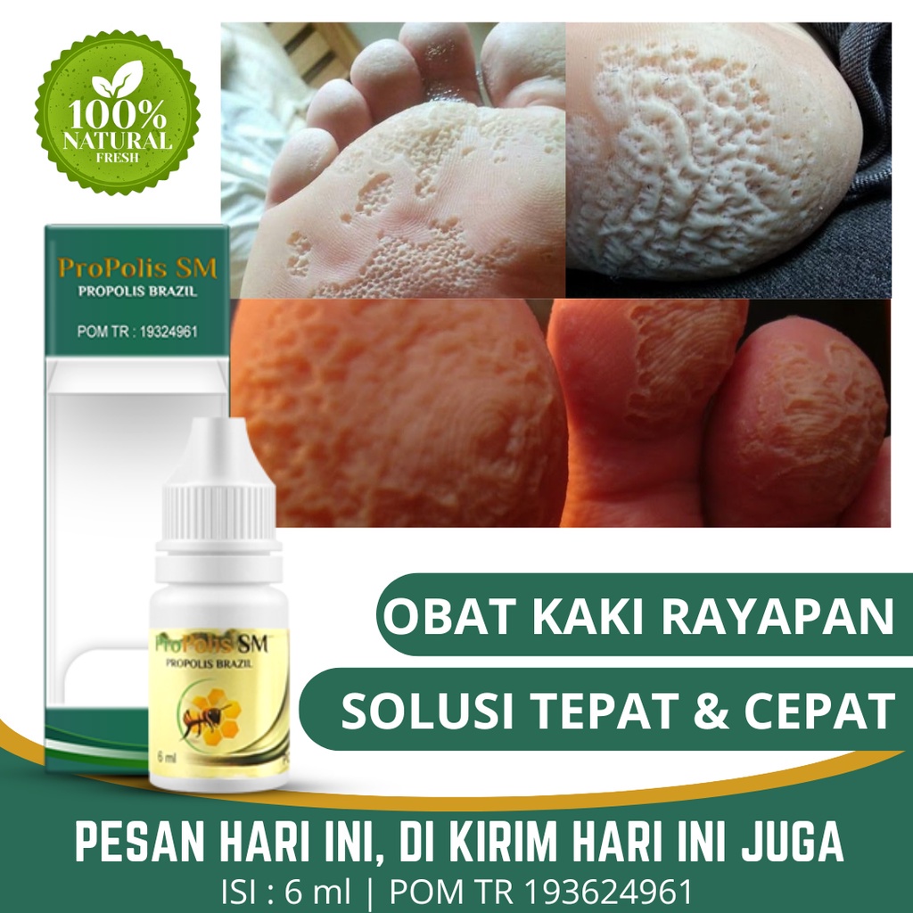 Obat Oles Kaki Rayapan, Obat Kaki Rayapan Bau, Obat Kaki Rayapan Berlubang, Obat Telapak Kaki Berlub