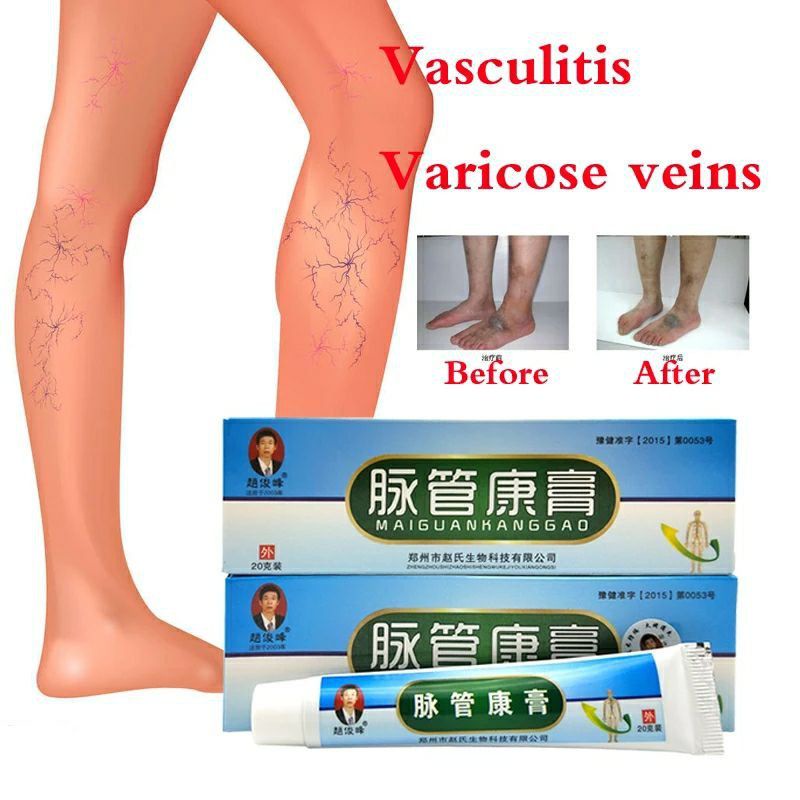 Obat penghilang varises Maiguankanggao krim varicose veins cream salep cina herbal parises Ampuh