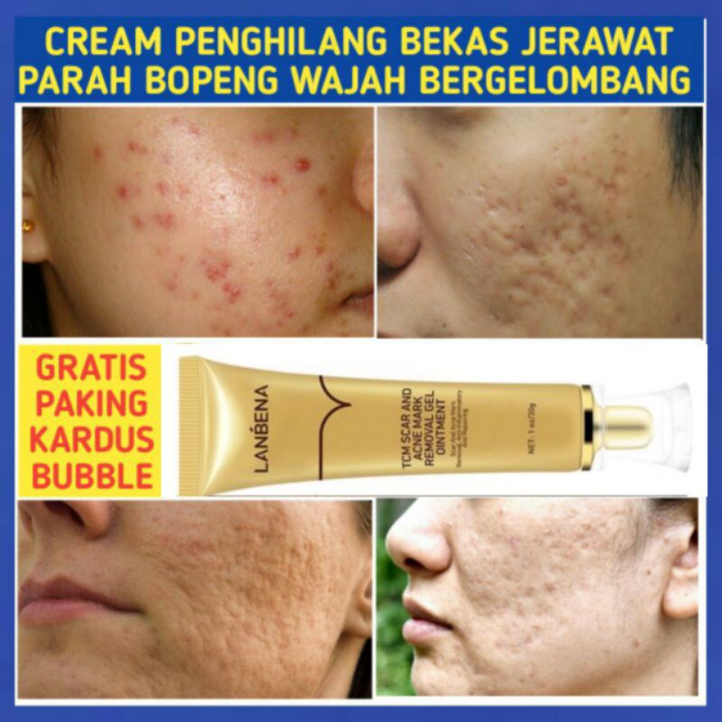 CREAM PENGHILANG BEKAS JERAWAT PARAH BOPENG KULIT WAJAH BERGELOMBANG XOD