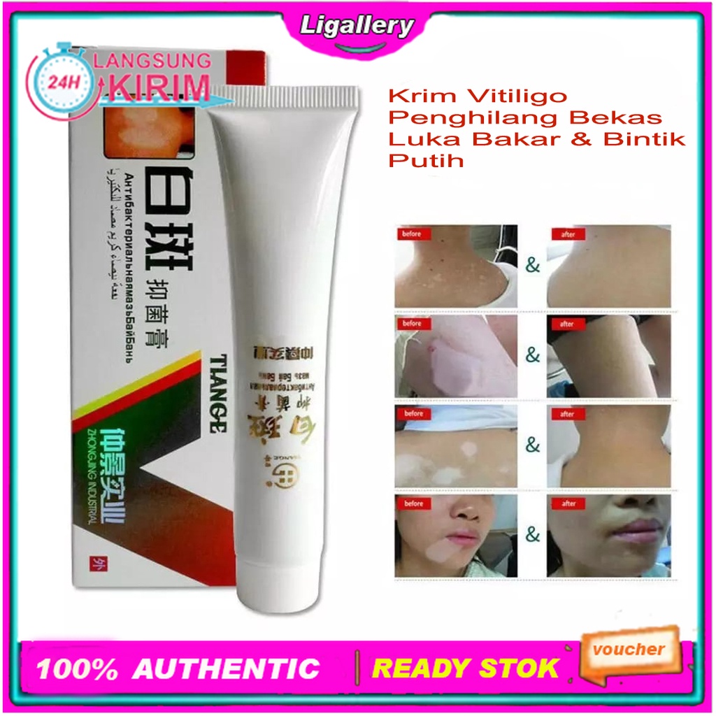 [100% ASLI] Cream Vitiligo Ampuh Salep Krim Vitiligo Penghilang Bekas Luka Bakar Dan Bintik Bintik Putih