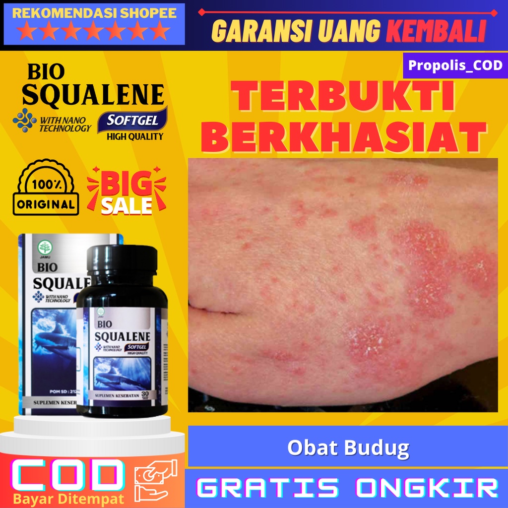 Obat Budug, Obat Budug Di Kaki, Obat Budug Santri , Obat Budug Bernanah, Obat Budug Cenang, Obat Bud