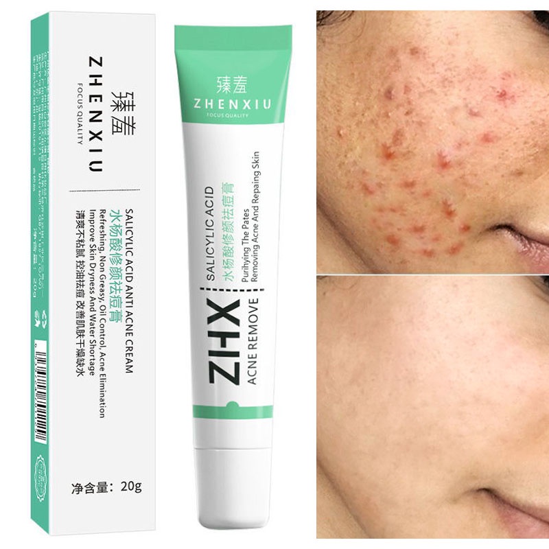 ZHENXIU Salicylic Acid Acne Treatment Cream 20Gr-Krim Anti Jerawat Salep Jerawat Menghilangkan Jerawat Memperbaiki Kulit Penghilang Bekas Luka