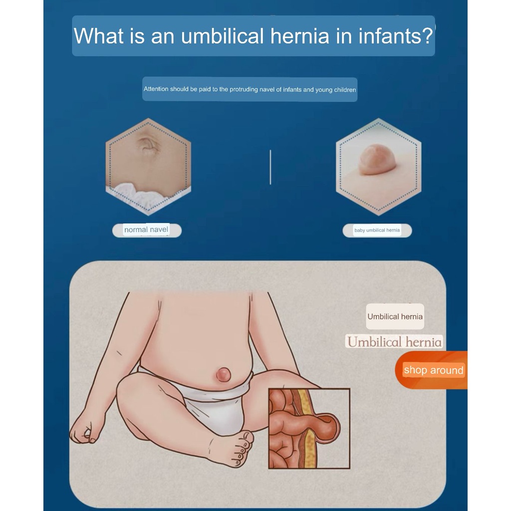 KOYO HERBAL HERNIA ANAK / PUSAR BODONG / Infant Umbilical HERNIA Patch / Koyo Herbal Bayi Anak / Stiker Hernia Bayi / Manjur