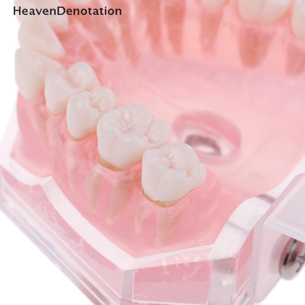 [HeavenDenotation] Plastik typodont orthodontic model Standar4004Dengan 28gigi Lepas HDV