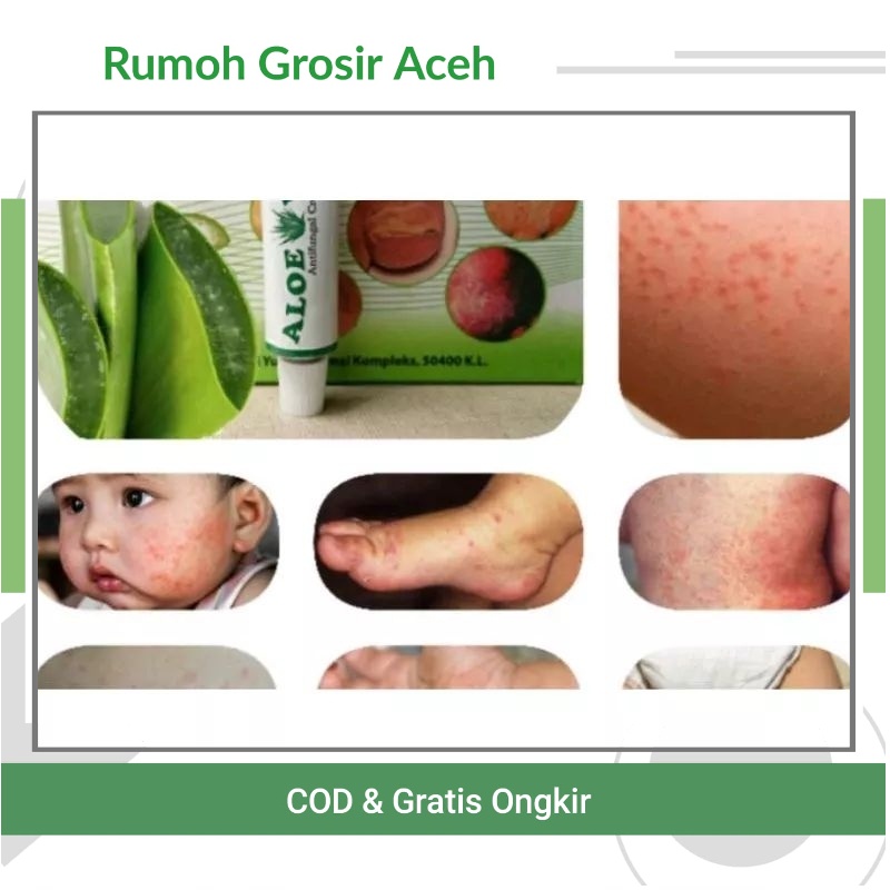 {ACEH} Salep Aloevera  MALAYSIA | 5gr Krim Salap Gatal Bayi Ruam Popok Ruam Leher Gatal Kelamin