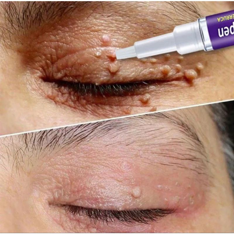 Cream Penghilang Tahi Lalat Kutil Ampuh EELHOE Tag // Wart Remover Pen Cream