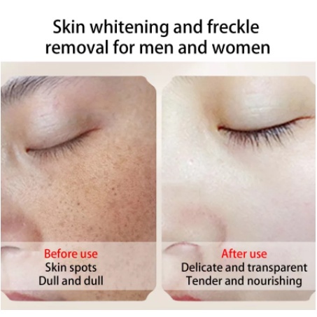 CINDYNAL Cream Penghilang Flek / Jerawat / Bintik Noda Hitam Gelap Komedo Pemutih Kulit Wajah Ampuh Pria Wanita Whitening Freckle Remove Dark Spots Krim Bekas Jerawat