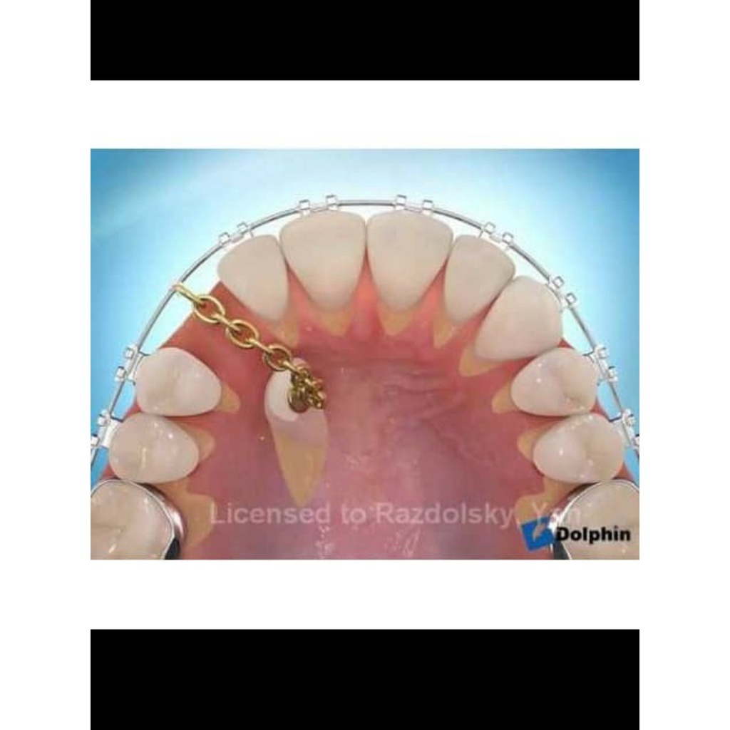 Button Chain/ Eruption Chain Gold Silver/ Exposure/ Windowing/ Rantai Gigi Taring RB7