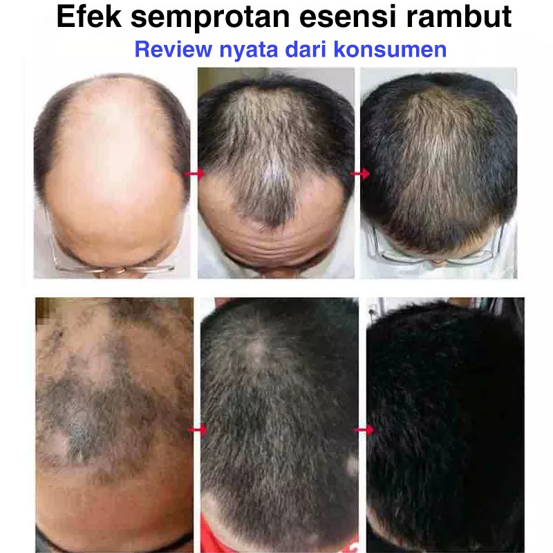 penumbuh rambut Hair growth serum penumbuh rambut botak serum penumbuh rambut 20ml serum rambut rontok Penumbuh Rambut Cepat