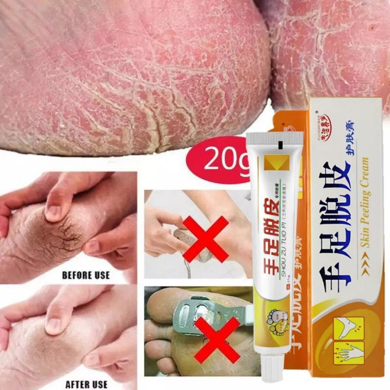 VERSI ORANGE OBAT SALEP TUMIT KAKI TANGAN KAPALAN KERING TEBAL RAYAPAN DAN PECAH AMPUH – SALEP KAKI PECAH KAPALAN KERING – OBAT TUMIT KASAR PECAH PECAH – CREAM KRIM TUMIT HALUS ORIGINAL AMPUH - SHOU ZU TOU