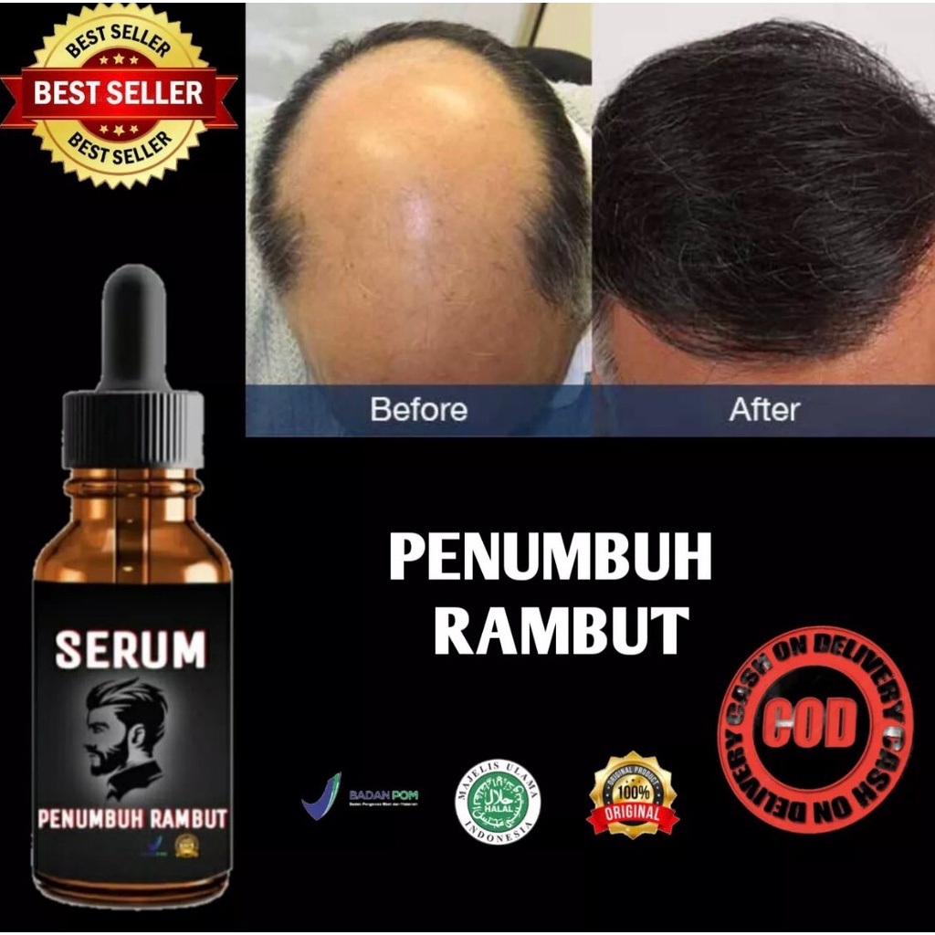 MINYAK PENUMBUH RAMBUT-SERUM PENUMBUH CEPAT PRIA DAN WANITA - Penumbuh Rambut Secara Cepat / Obat Pe