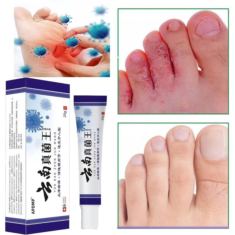 【COD】 krim perawatan anti bakteri , menghilangkan jamur tinea pedis , salep perawatan kaki, krim per