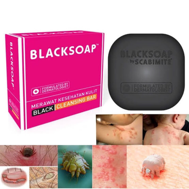 SCABIMITE BLACKSOAP CLEANSING BAR*