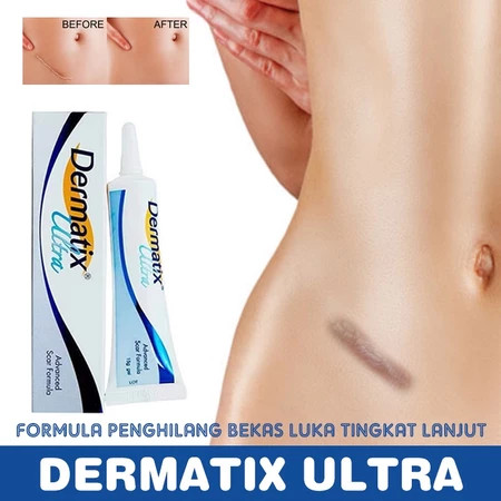 [100%ORI]Dermatix Ultra Cream 15gr Penghilang Bekas Luka Operasi Keloid - Luka Lama - Bakar