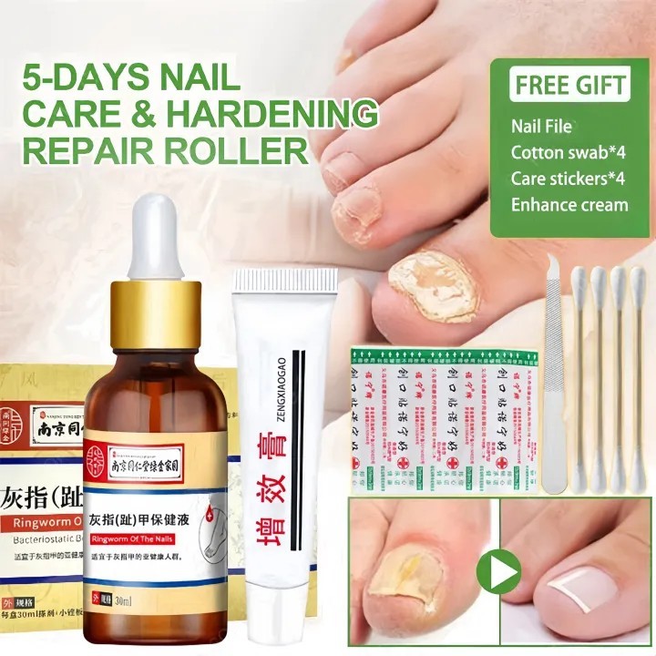 obat kuku jamur dan rusak Perawatan Kuku Berjamur Serum Penghilang Jamur Di Kuku Vitamin Kuku Rusak 