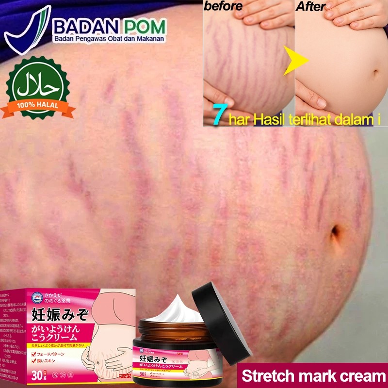 【BPOM】Krim Penghilang Stretch Mark Penghilang Stretch Mark Paling Ampuh Penghilang Stretch Mark 30g 