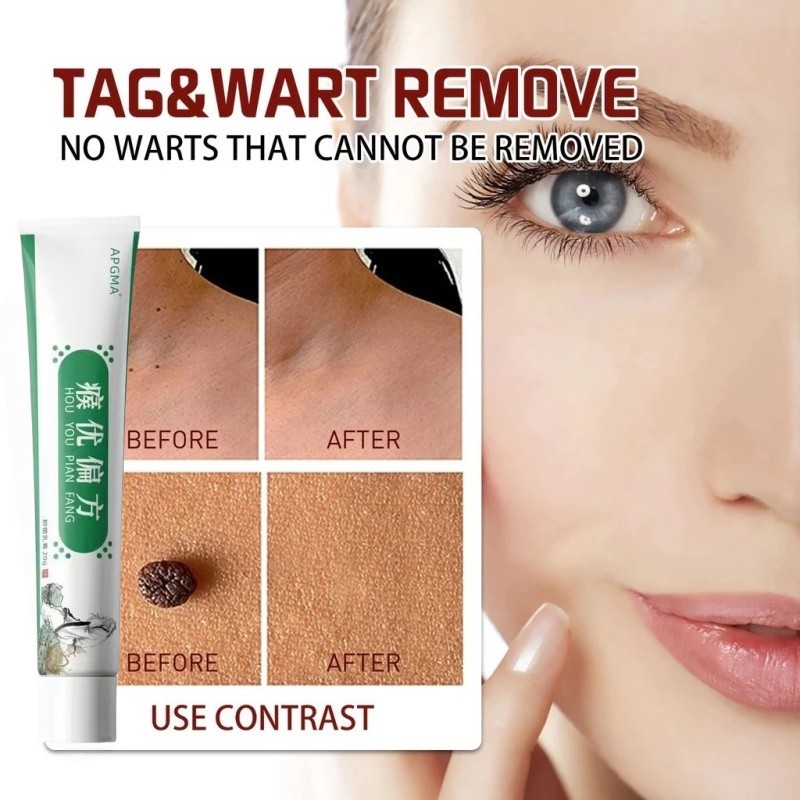 Obat kutil 20g Kutil hilang dalam 1 detik obat kutil paling ampuh oles obat kutil Krim Penghilang Ku