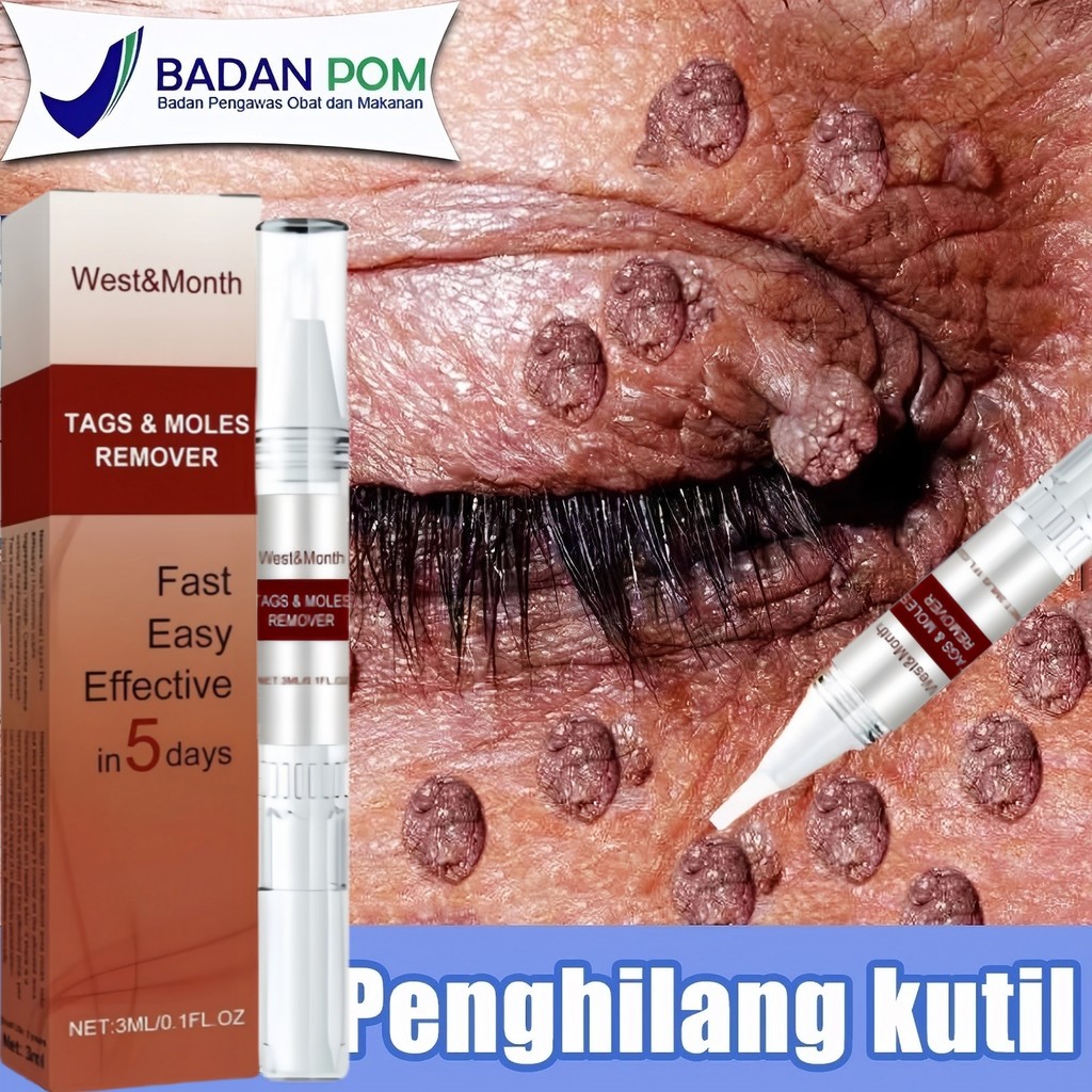 Penghilang kutil Penghilang tahi lalat di wajah Penghilang kutil dan tahi lalat Penghilang tahi lala