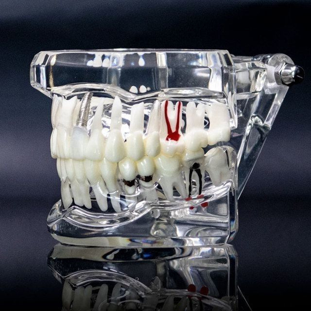 Model study gigi edukasi transparan studi implant phantom crown karies bridge bening impaksi model g