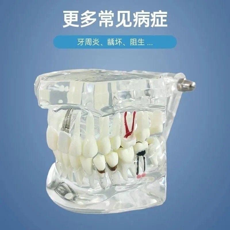 Model gigi edukasi transparan studi implant phantom crown karies bridge bening impaksi model gigi bi