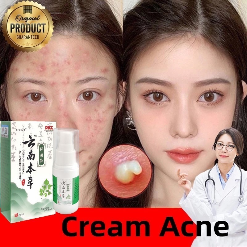 Menghilangkan bopeng dan flek hitam, mengobati jerawat dan bekas jerawat.Penghilang jerawat obat jer