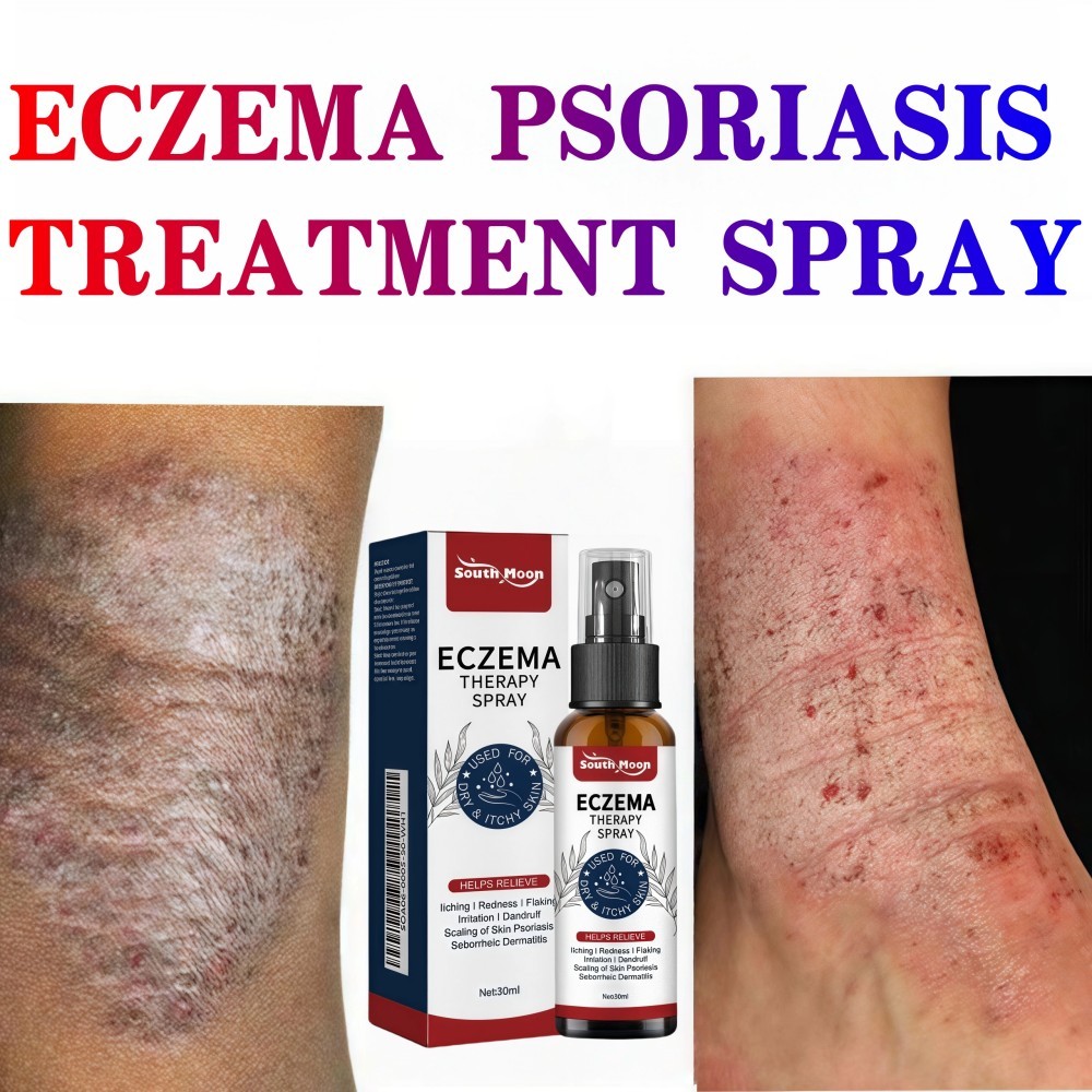 [100% asli] Semprotan anti gatal, semprotan eksim, obat psoriasis, semprotan psoriasis, obat gatal k