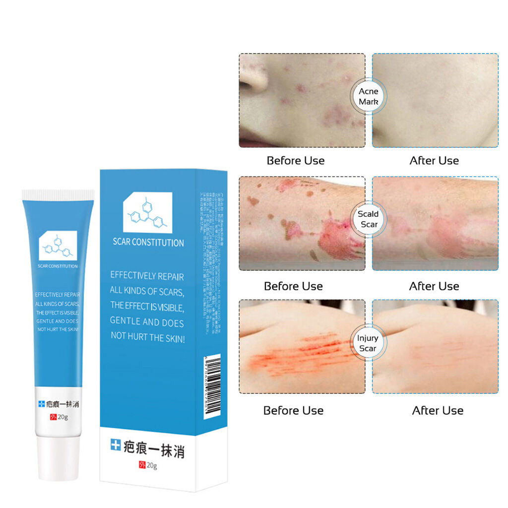 50%OFF 20g Scar Cream Scar Removal Cream Peklat Remover Acne Treatment Scar Remover Cream To Fade Ac