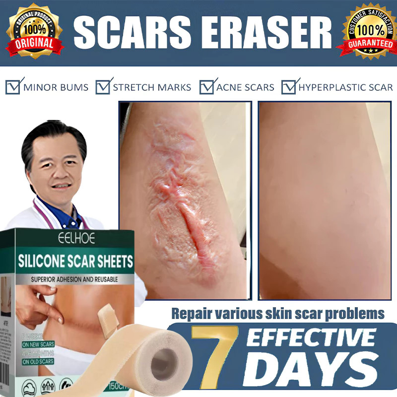 EELHOE Dermaline Silicone Keloid 1Roll Keloplast Silicone Keloid Plester Scar Tape Keloid Bekas Luka