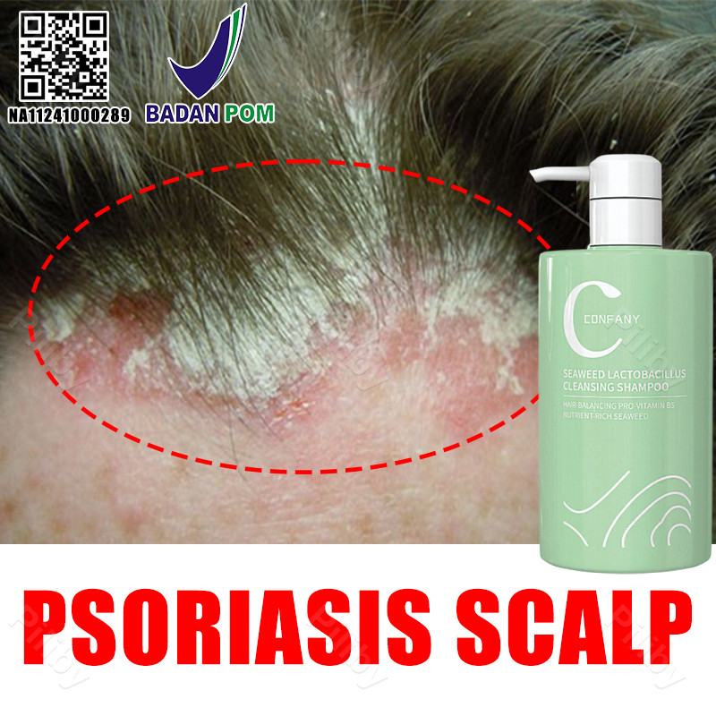 shampoo anti ketombe dan gatal Penghilang ketombe berkerak dan gatal psoriasis shampoo penghilang ke