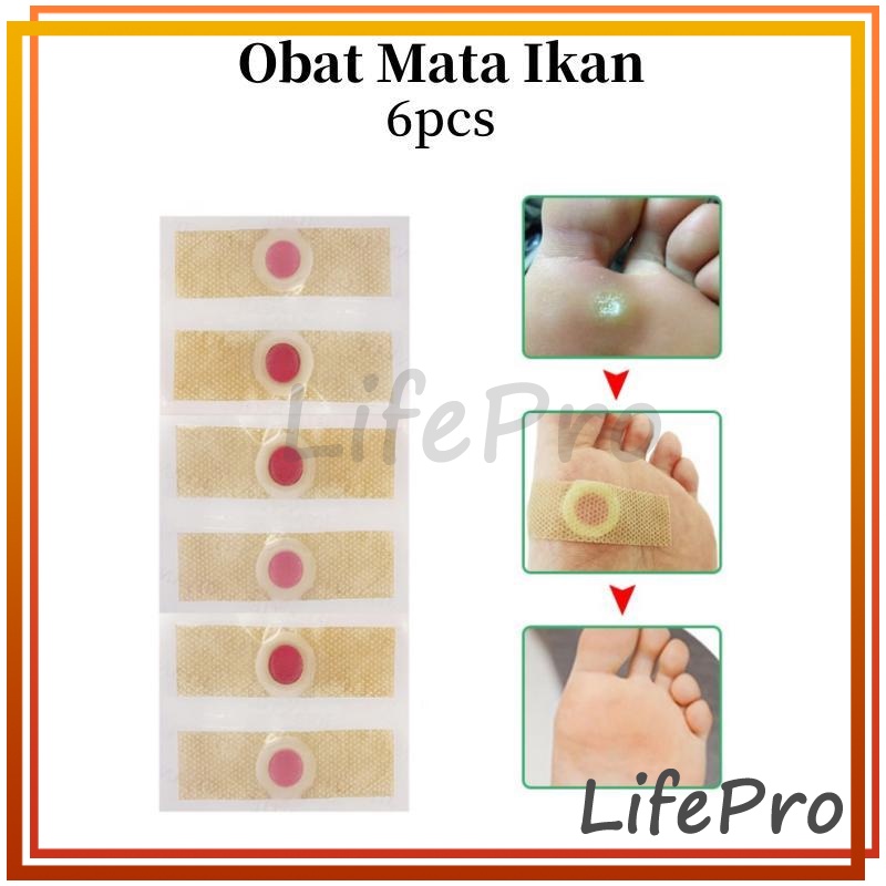 Plester Mata Ikan dan Kutil 6 Pcs / 1 Strip Obat Mata Ikan / Kapalan / Callusol / Asam Salisilat Foo