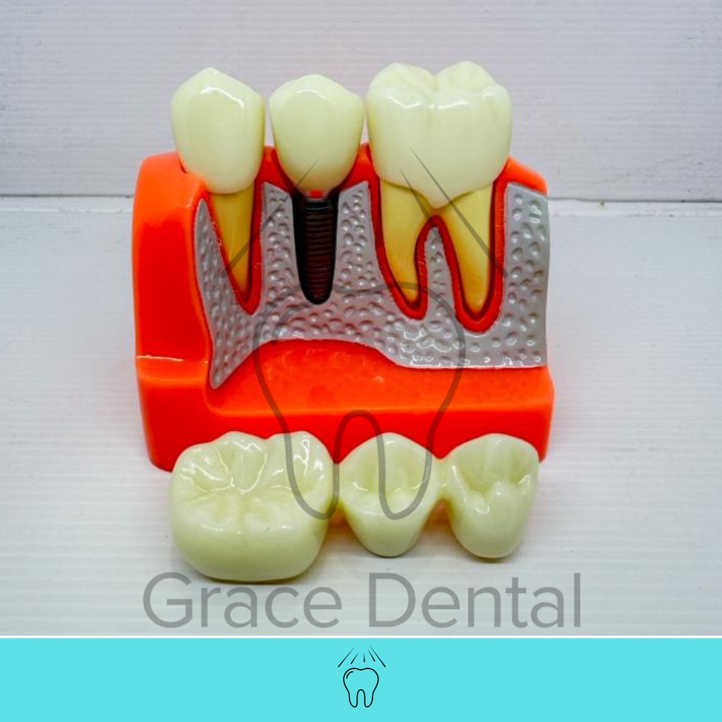 Model Implant Bridge Gigi Mahkota Jembatan Crown Dental