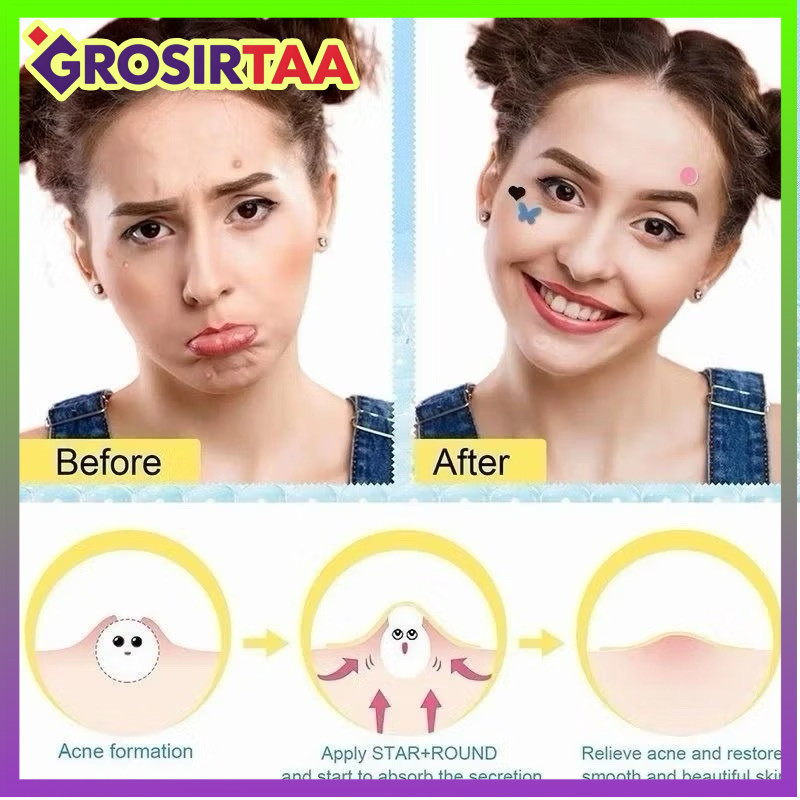 COD makassar Acne Pimple Patch 1 Lembar Isi 36 Patch / Stiker Jerawat Hydrocolloid / Sticker Perawat