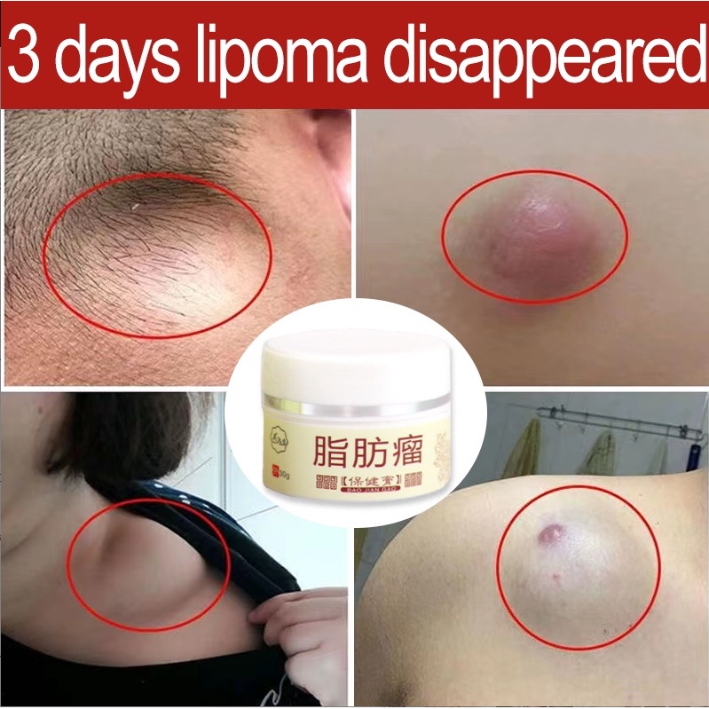 Obat Benjolan Lipoma Obat herbal Cina Krim lipoma 30g Perawatan punggung/leher/paha Kanker Tumor Kel