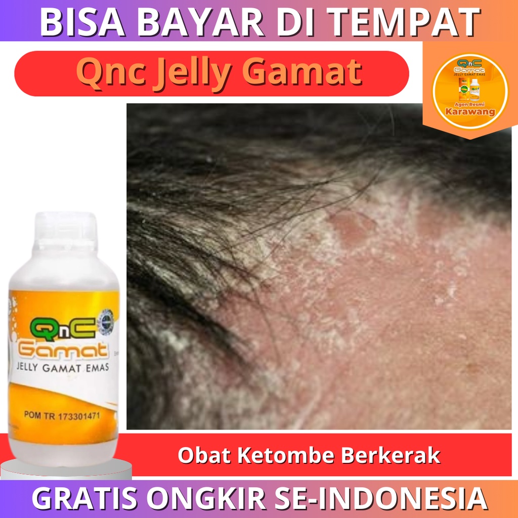 Propolis Asli Original - Obat Ketombe Berkerak Di Kulit Kepala Jamur Kulit Kepala Obat Ketombe Psori