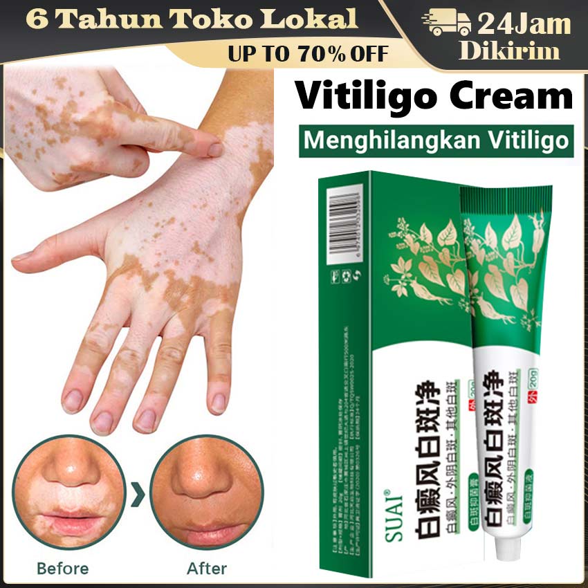 Cream Vitiligo 100 % Original / Salep Obat Vitiligo / Vitiligo Obat Salep Penyakit Kulit - Bercak Pu