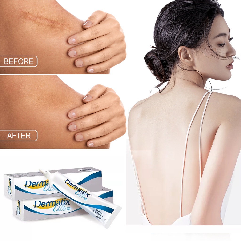 Dermatix Ultra Gel Original Salep Dermatix Penghilang Bekas Luka15g Gel Pemudaran Bekas Luka Perbaik