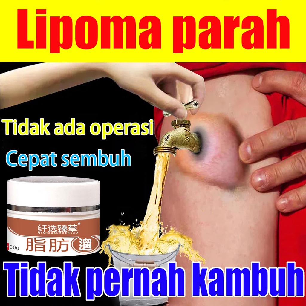 Paket baru Obat Benjolan Lipoma Krim lipoma OBAT OLES PENGHILANG BENJOLAN LIPOMA  Obat Kista Ganglio