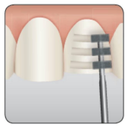 

Dental Jaya Bur Veneer | Deep Marker | Diamond Bur