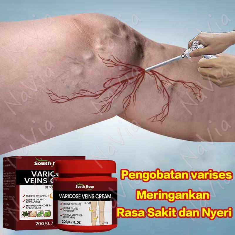 【NaVia】Krim Perbaikan Varises/Tumpul Nyeri betis Oedema Urat biru menonjol Pembengkakan pembuluh dar