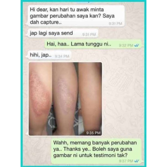 Meilibahenling BPOM Penghilang Bekas Luka Penghilang Bekas Cacar Koreng Bopeng Penghilang Jerawat Penghilang Strechmark