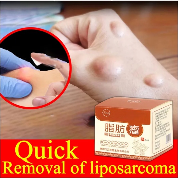 Obat Benjolan Lipoma Krim lipoma OBAT OLES PENGHILANG BENJOLAN LIPOMA 30g Obat Kista Ganglion, Obat 