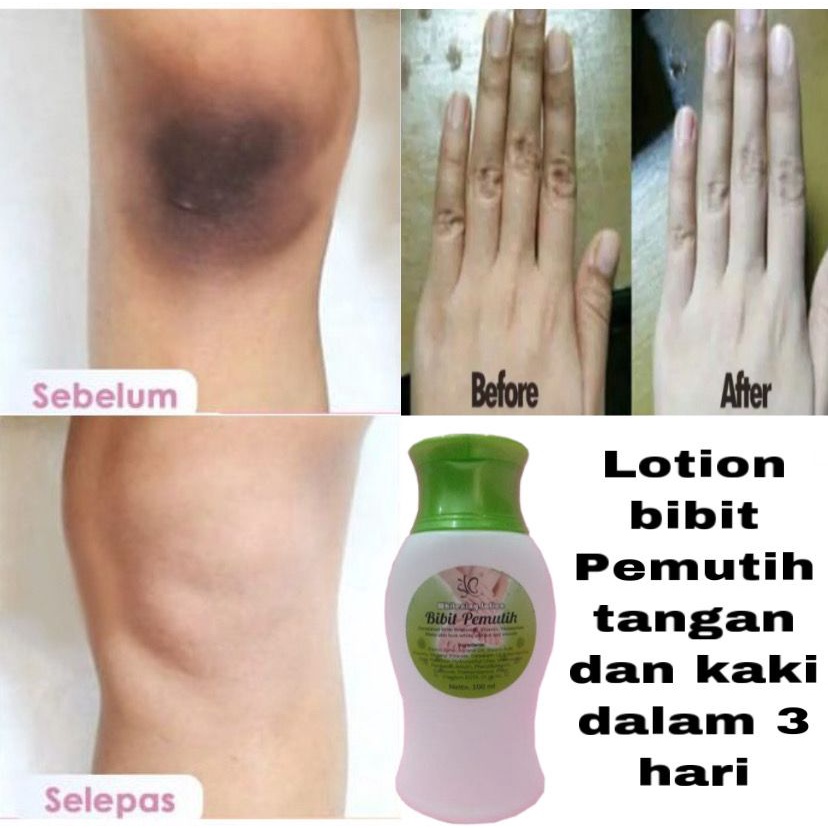 LOTION BIBIT PEMUTIH TANGAN DAN KAKI PERMANEN DALAM 3 HARI PENGHILANG KULIT BELANG TANPA EFEK SAMPIN