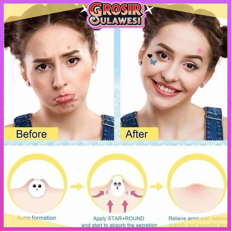 COD makassar Acne Pimple Patch 1 Lembar Isi 36 Patch / Stiker Jerawat Hydrocolloid / Sticker Perawat
