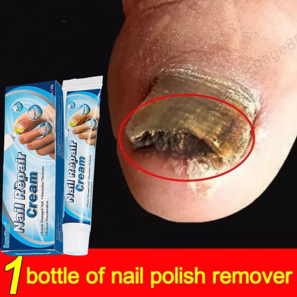 [BPOM] Obat jamur kuku Obat kuku jamur dan rusak vitamin kuku rusak 30g Obat kuku cantengan jempol k