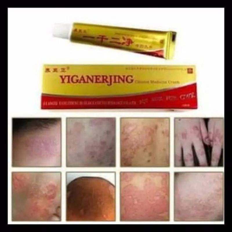 obat cina tradisional penyakit kulit dermatitis Anti bakteri kudis S