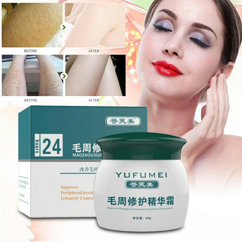 YUFUMEI face body Curing Skin kulit ayam Keratosis Skin Repair Chicken skin Pilaris acne jerawat ORI