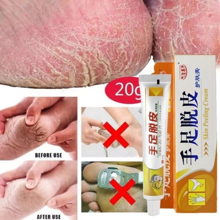 SALEP HUATUO KULIT KERING PECAH PECAH  20gr KAPALAN Shou zu tuo pi skin peeling cream Melembabkan ku