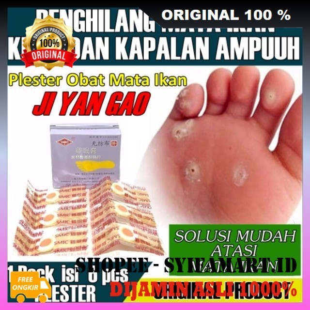 Obat Mata Ikan di Telapak Kaki Ampuh Ji Yan Gao Isi 6 Plester ORIGINAL