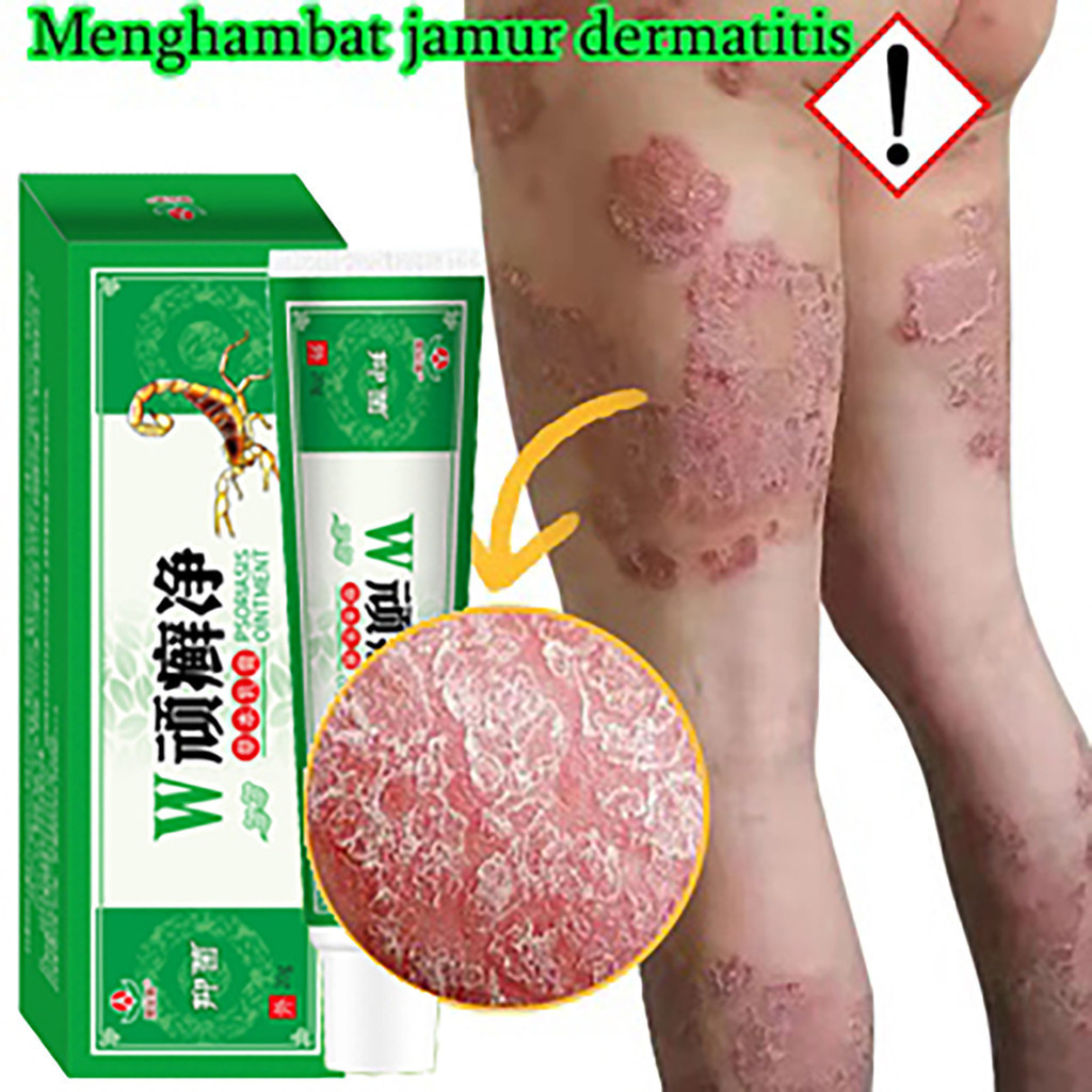 Salep obat kulit gatal Gatal - Obat Gatal Selangkangan Eksim Dan Jamur Budug Bernanah Scabies Manusi