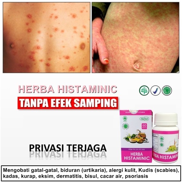 Kapsul Obat Gatal Gatal Di Selangkangan Kudis Eksim Paling Ampuh